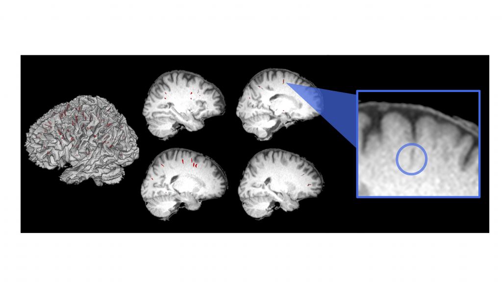 This composite of astronaut brain scans shows changes related to spaceflight. Courtesy Juan Piantino, M.D.