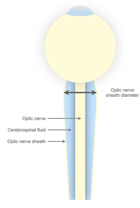 A simple schematic of the optic nerve and the sheath with cerebrospinal fluid. Image Credit: Netteland et al. 2023.